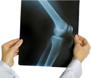 Röntgen bei Kniearthrose